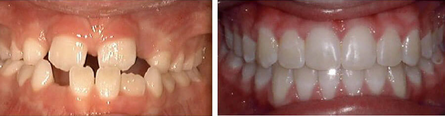 Before and after photos for braces for kids showing crooked teeth before and straight teeth after performed by Dr. Perry in Patchogue, NY at Harbor Family Orthodontics. Serving Medford, Sayville, and all of Long Island, NY