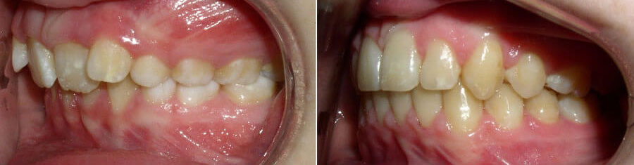 Side view of before and after photos for braces for kids showing crooked teeth before and straight teeth after.