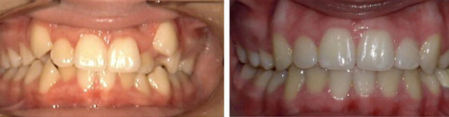 Before and after photos for braces for kids showing crooked teeth before and straight teeth after performed by Dr. Perry in Patchogue, NY at Harbor Family Orthodontics