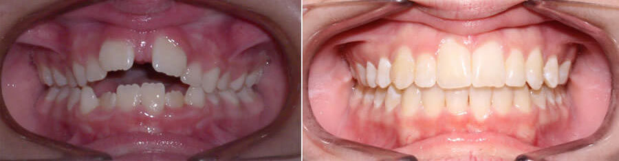 Before and after photos for braces for kids showing crooked teeth before and straight teeth after orthodontics for kids performed by Dr. Perry in Patchogue, NY at Harbor Family Orthodontics