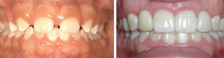 Before and after photos for braces for kids showing crooked teeth before and straight teeth after at Dr. Perry's practice in Patchogue, NY. Harbor Family Orthopedics - Braces and Orodontics for Kids