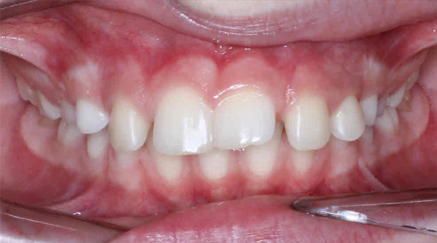 Motuh showing straighter teeth after Invisalign treatment.