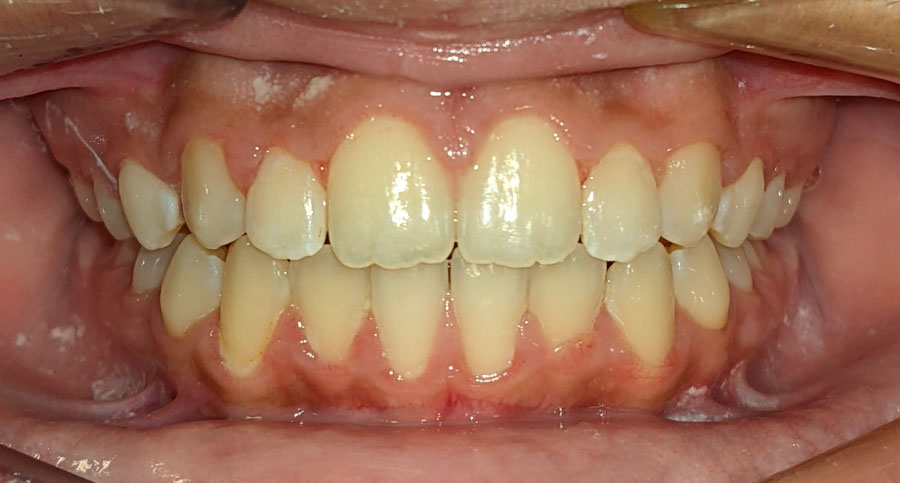 Mouth showing straight teeth after Invisalign treatment.