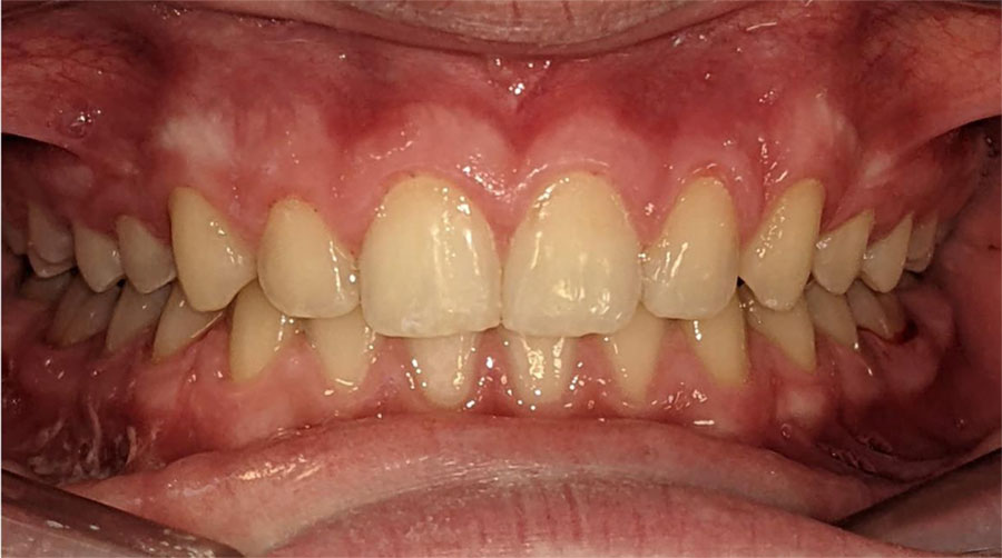 Mouth showing overbite before Invisalign treatment.