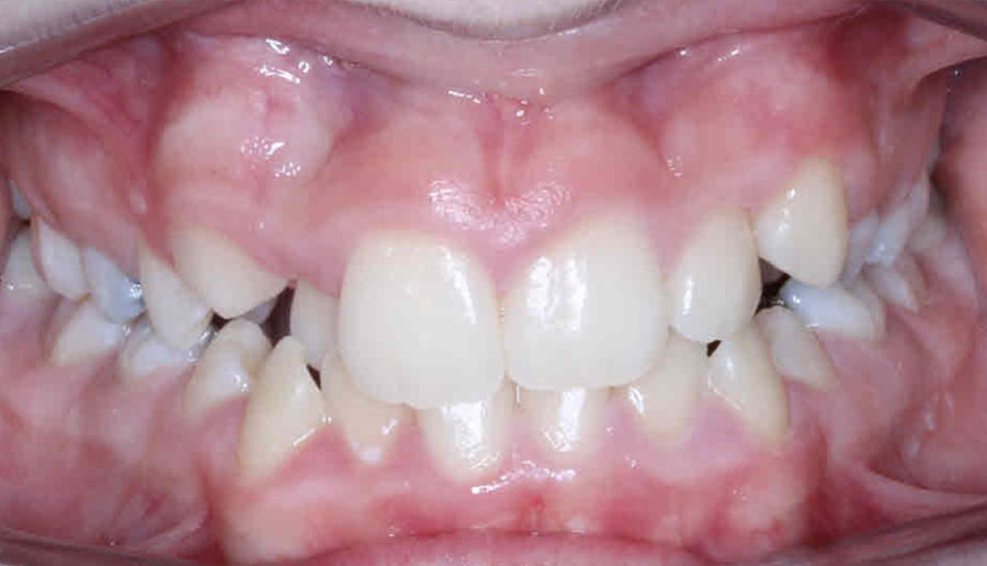Mought showing straighter teeth after Invisalign treatment.