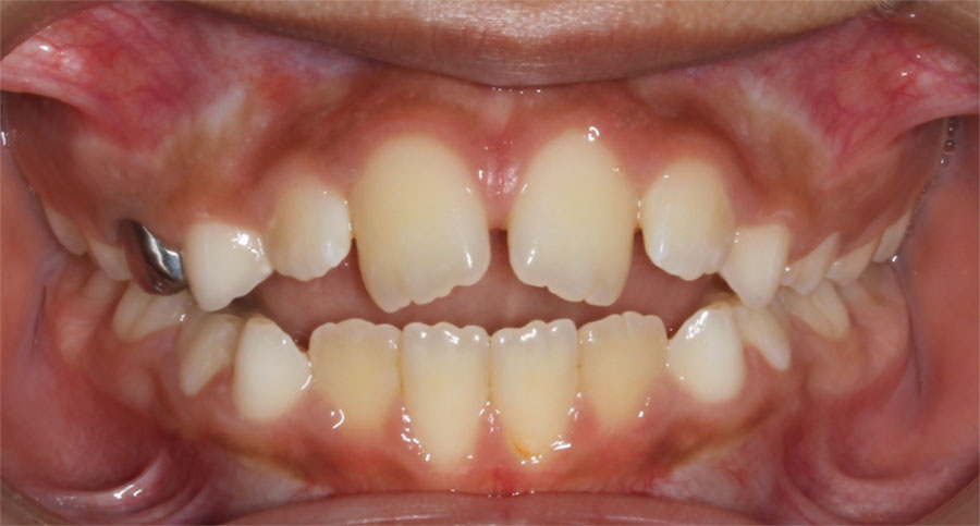 Mouth showing crooked teeth before Invisalign treatment.