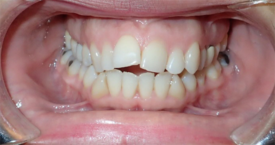 Mouth showing crooked teeth before Invisalign treatment.