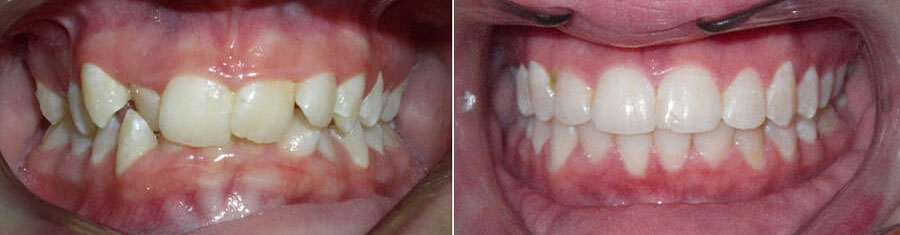 Before and after photos for orthodontics and traditional braces treatment showing crooked teeth before and straight teeth after.