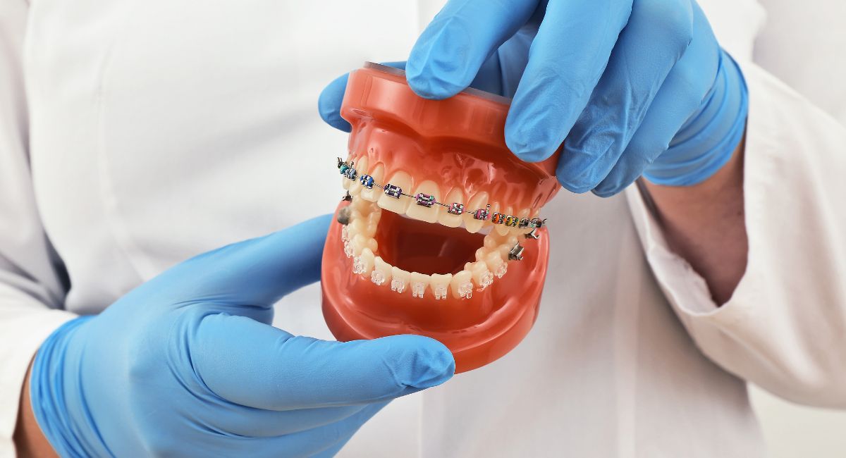model of teeth and mouth in dental setting with braces on teeth