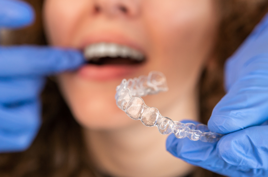 8 Things About Invisalign Attachments That You Need to Know