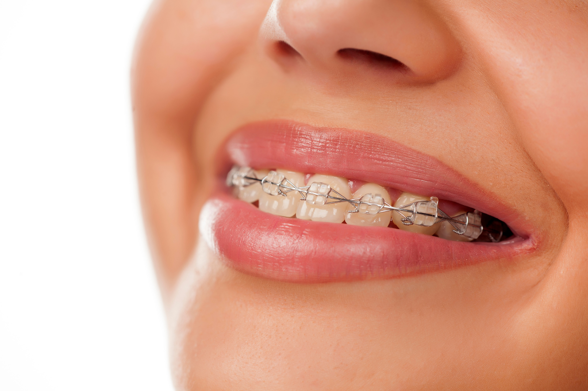 Invisalign vs. Braces: Which One Suits Me Best?