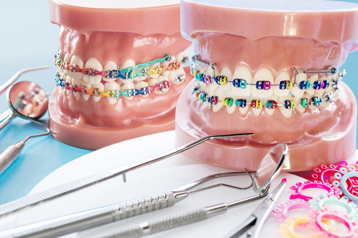 Braces: Which Type of Braces is the Best Choice?​