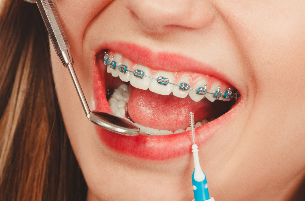 6 Signs Your Kid Needs Braces