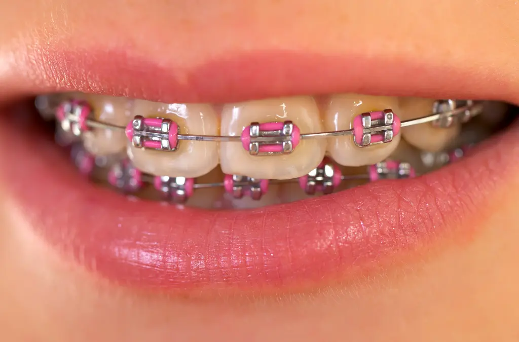 pink color braces