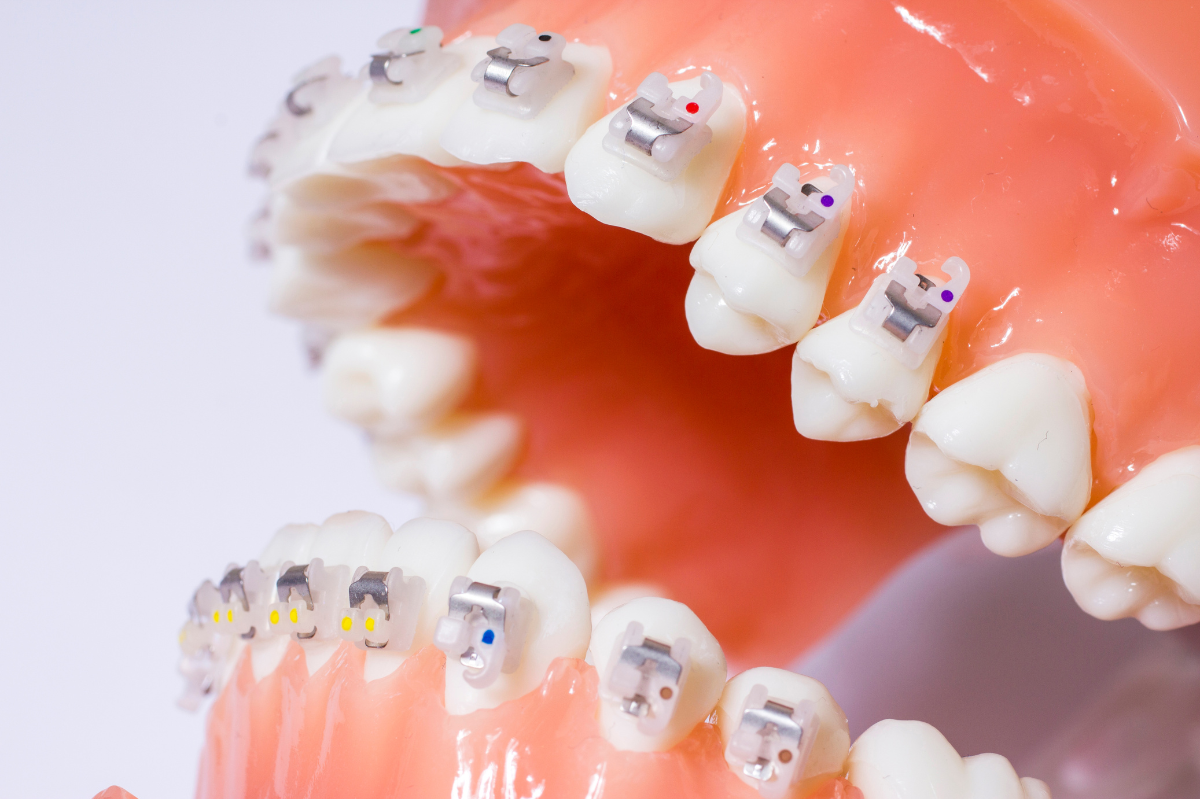 Headgear and Braces: What You Need to Know as an Orthodontic Patient