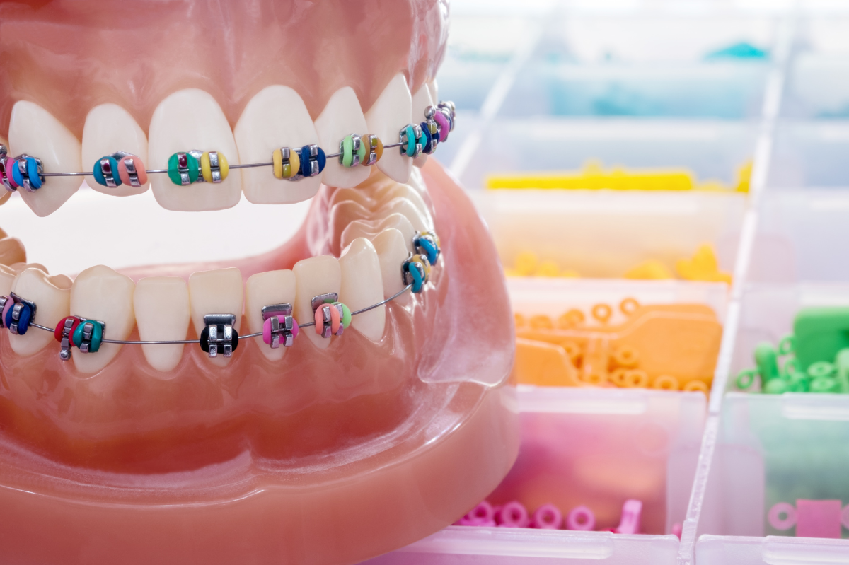 The Orthodontic Advantage: Getting the Best Outcome with Braces and Invisalign