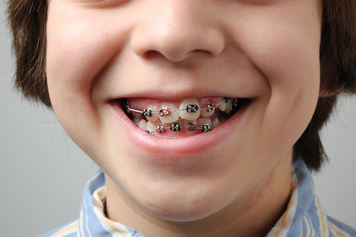 Braces for Kids A Comprehensive Guide to Age, Cost, and Benefits